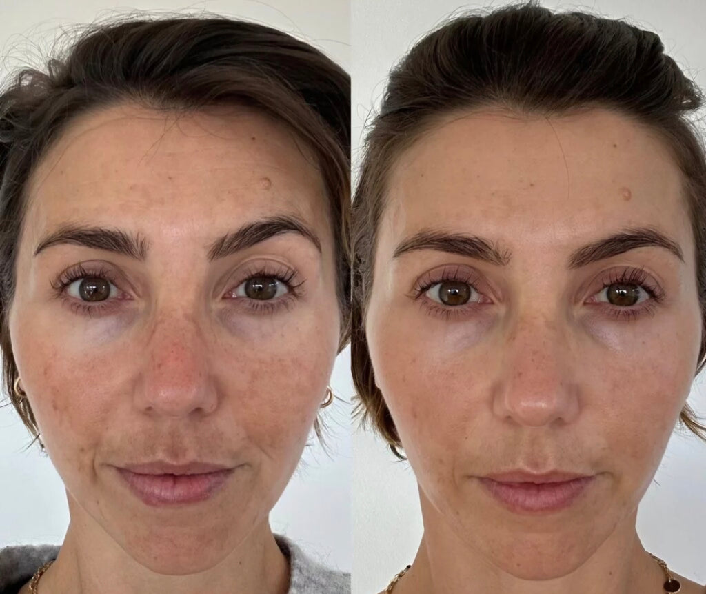 Derma Roller