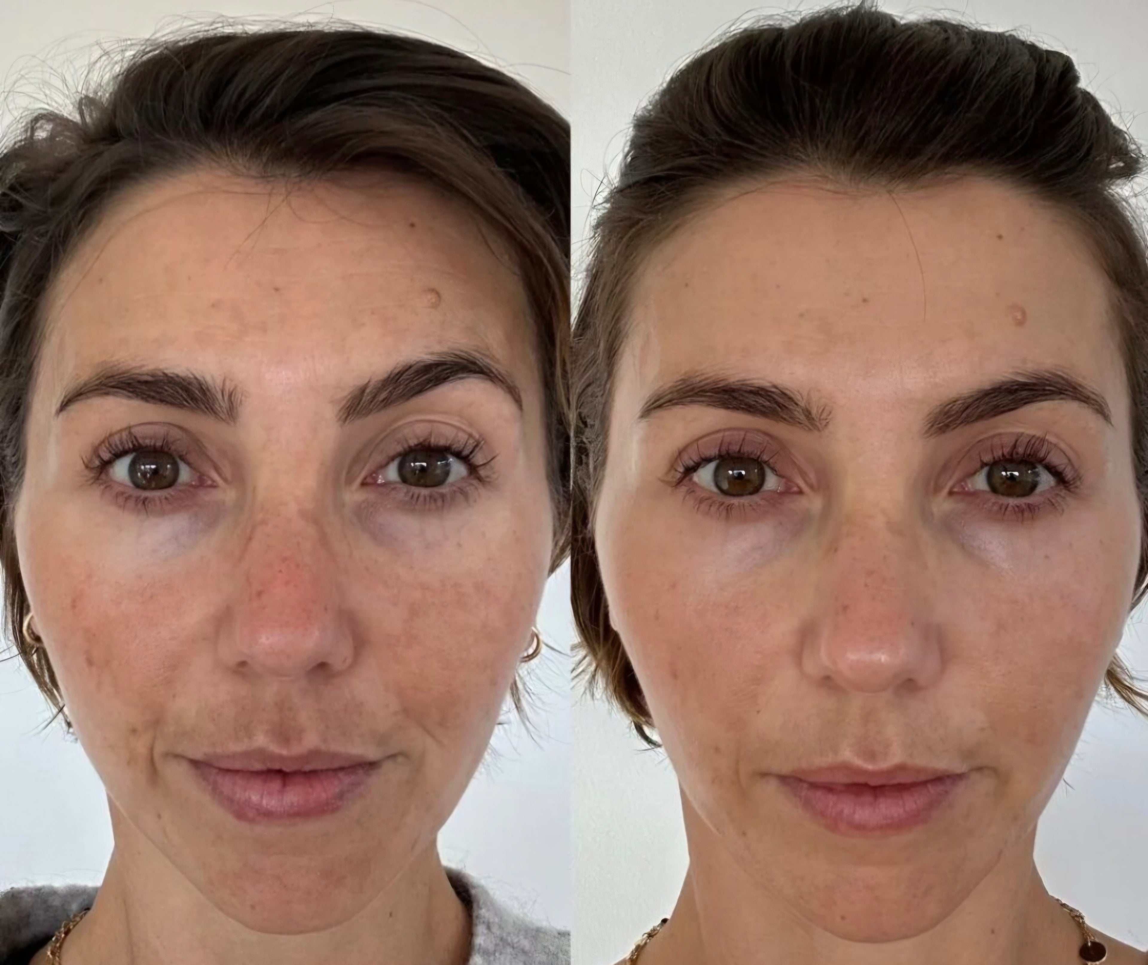 Derma Roller
