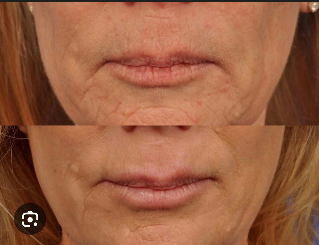 Derma Roller