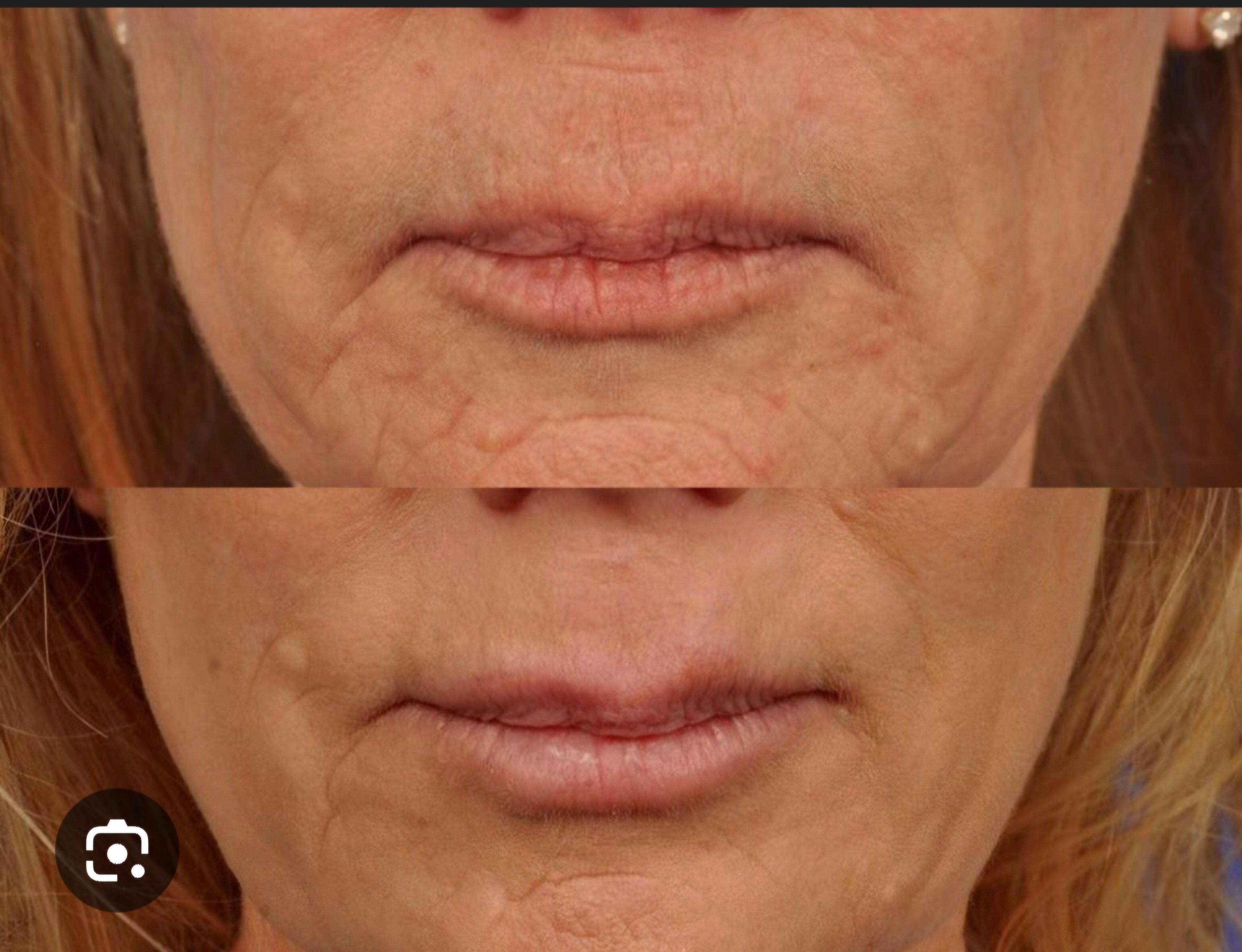 Derma Roller